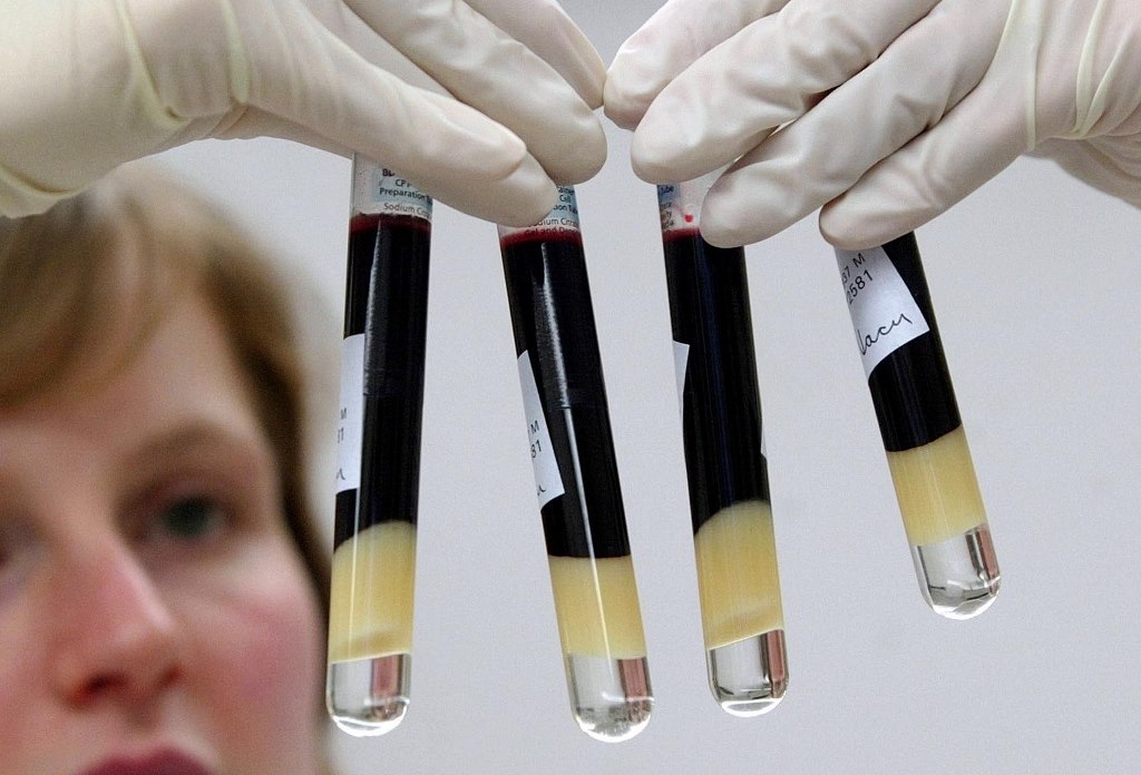 HIV: Νέα μέθοδος ξετρυπώνει τα κρυμμένα μολυσμένα κύτταρα