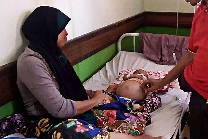 Απίστευτο! Αφαίρεσαν παρασιτικό έμβρυο από αγοράκι στην Ινδονησία
