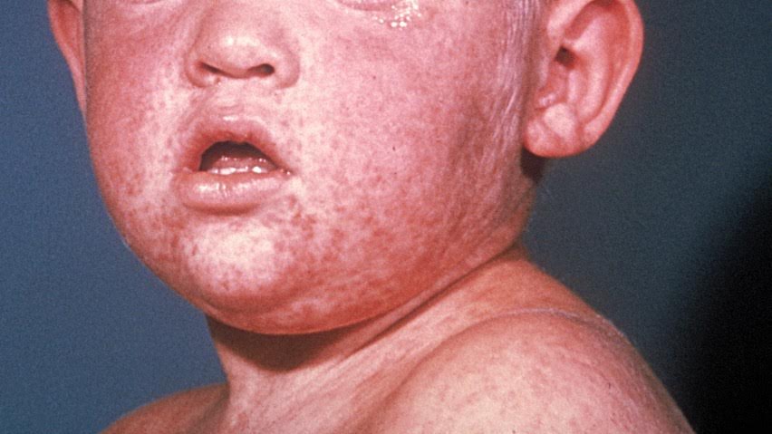 Ιλαρά: Κίνδυνος επιδημίας στην Ευρώπη επειδή κάποιοι αρνούνται να εμβολιάσουν τα παιδιά τους