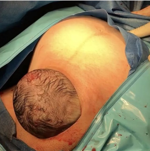 Η «απαλή καισαρική»: Μωράκι βγάζει το κεφάλι του από το στομάχι της μητέρας (Video)