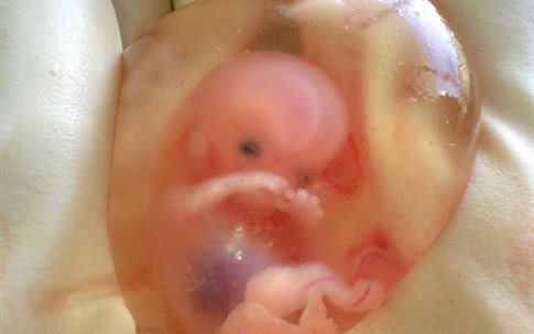 Σοκ! Έμβρυο μεγαλώνει σε σπλήνα εγκύου