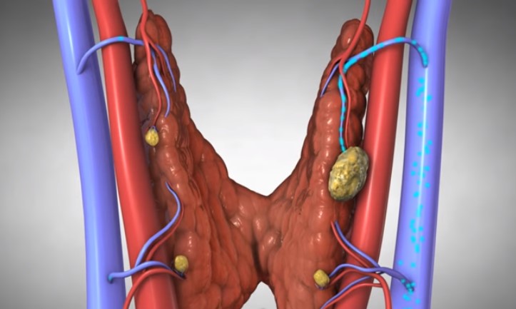Θυροειδής: Νέος τρόπος αφαίρεσης χωρίς τομές, από το στόμα
