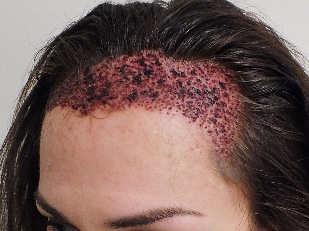 Προειδοποιήσεις γιατρών για «αφύσικα αποτελέσματα» μετά από μεταμοσχεύσεις μαλλιών – Το τουρκικό παράδειγμα