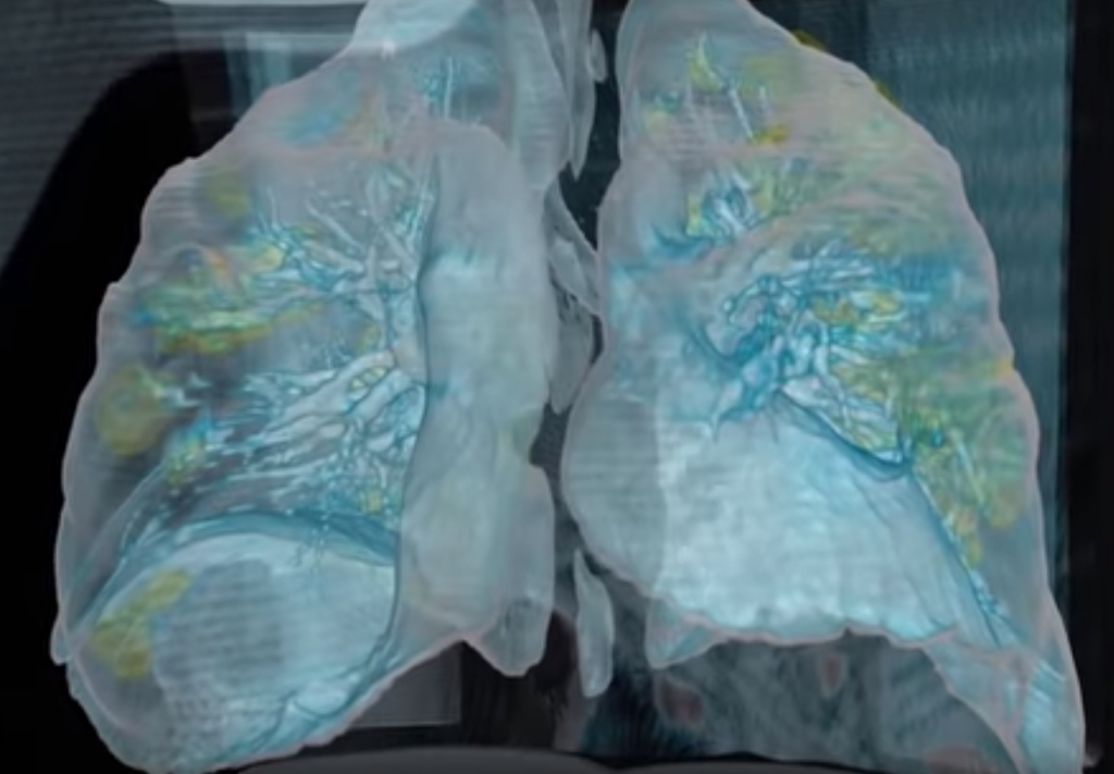 Κορονοϊός: Συγκλονιστικό βίντεο αποκαλύπτει βλάβη στους πνεύμονες μέχρι πρότινος ασυμπτωματικού ασθενή