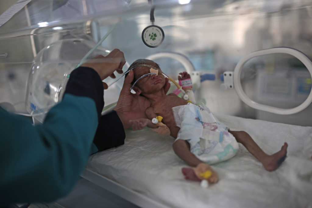 Υεμένη: Σε τραγικά επίπεδα έχει φτάσει ο υποσιτισμός των παιδιών