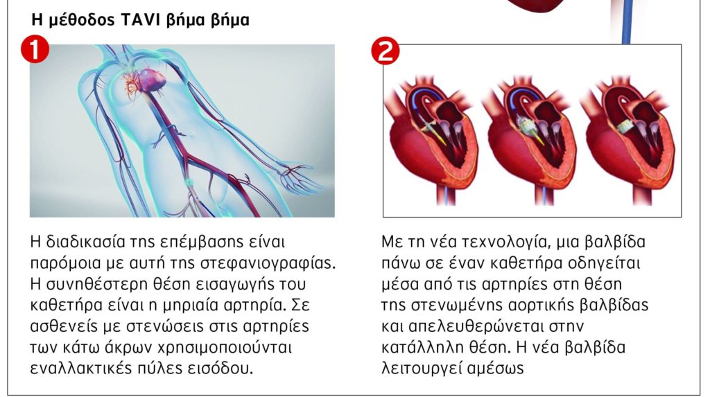 Metropolitan Hospital: Αντικατάσταση αορτικής βαλβίδας (TAVI) χωρίς διάνοιξη του θώρακα