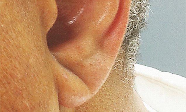 Πως τα αυτιά δείχνουν αν κινδυνεύουμε από εγκεφαλικό (Photos)