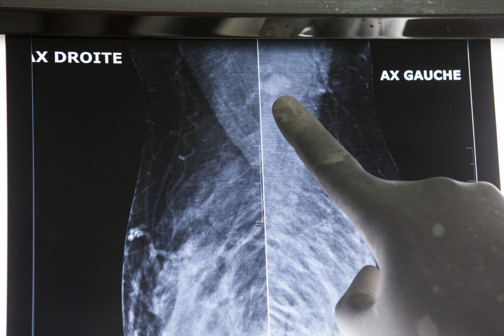 Ελπιδοφόρα νανοσυσκευή για την καταπολέμηση του καρκίνου του μαστού