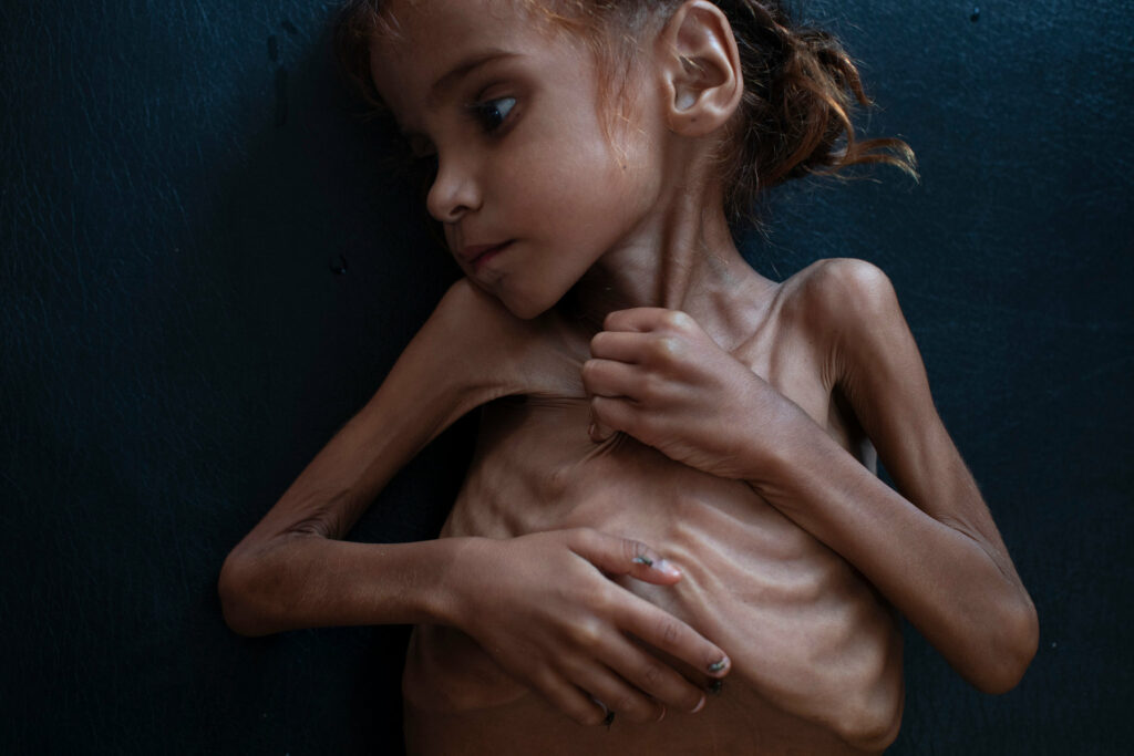 Υεμένη: Πέθανε από την πείνα η 7χρονη, σύμβολο του λιμού