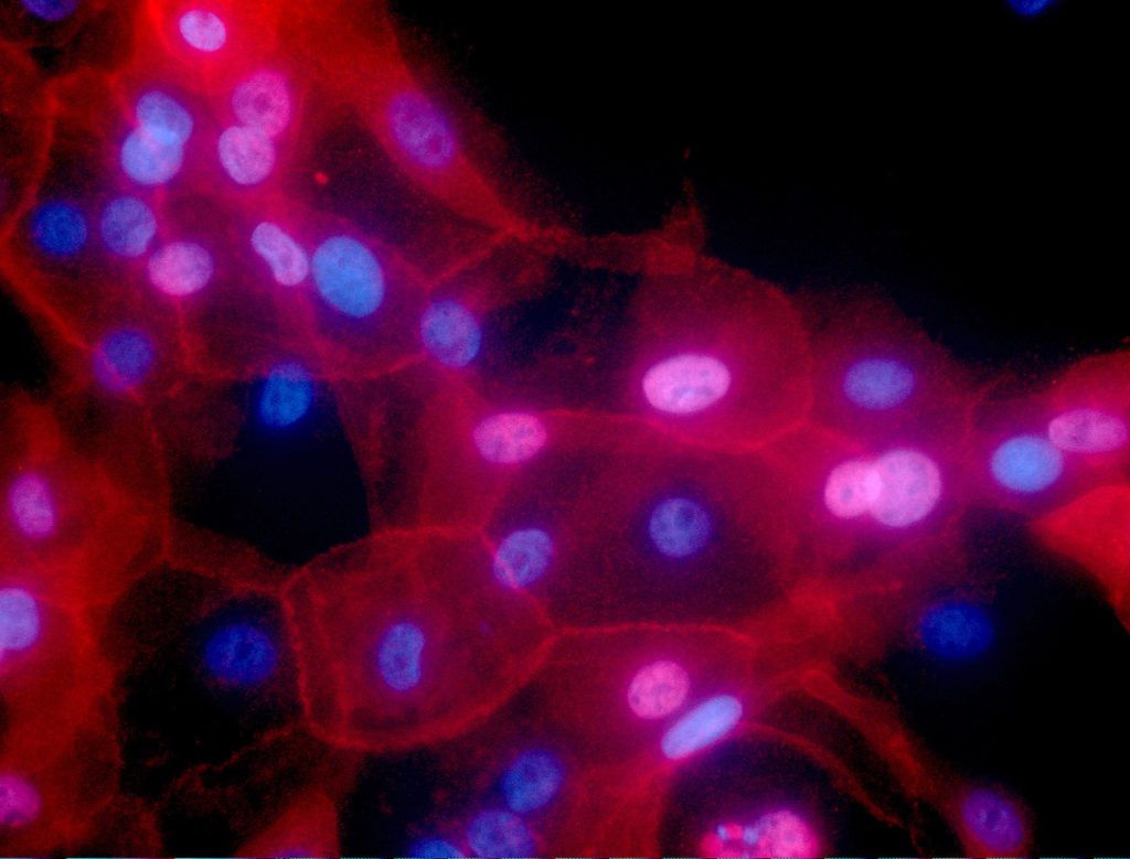 Βρετανία: Ελπίδες για θεραπεία του καρκίνου μέσω ιού που εξοντώνει επιβλαβή κύτταρα