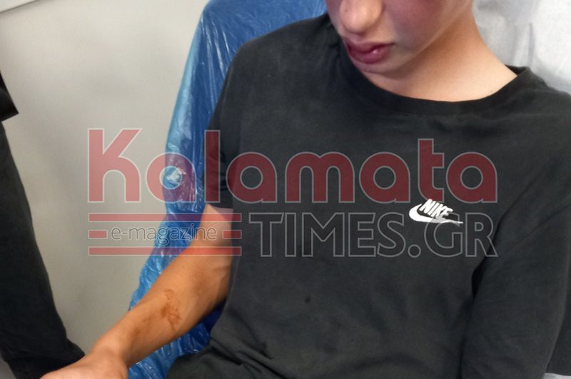 Καλαμάτα: Άγριος ξυλοδαρμός 16χρονου από παρέα ανηλίκων – «Χτυπούσαν το παιδί μου δίχως αύριο», είπε η μητέρα (Video)