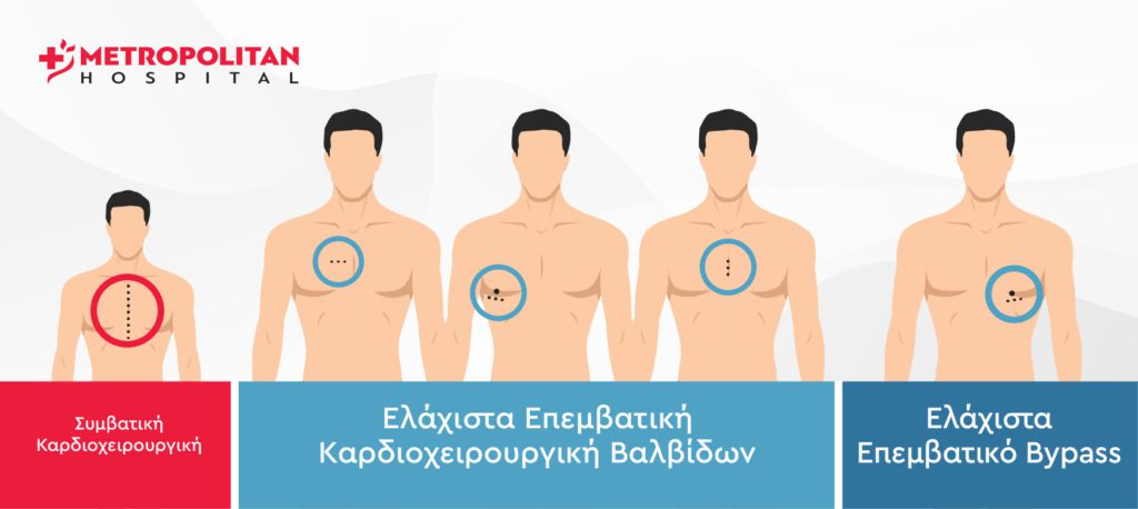 Ελάχιστα Επεμβατική Καρδιοχειρουργική