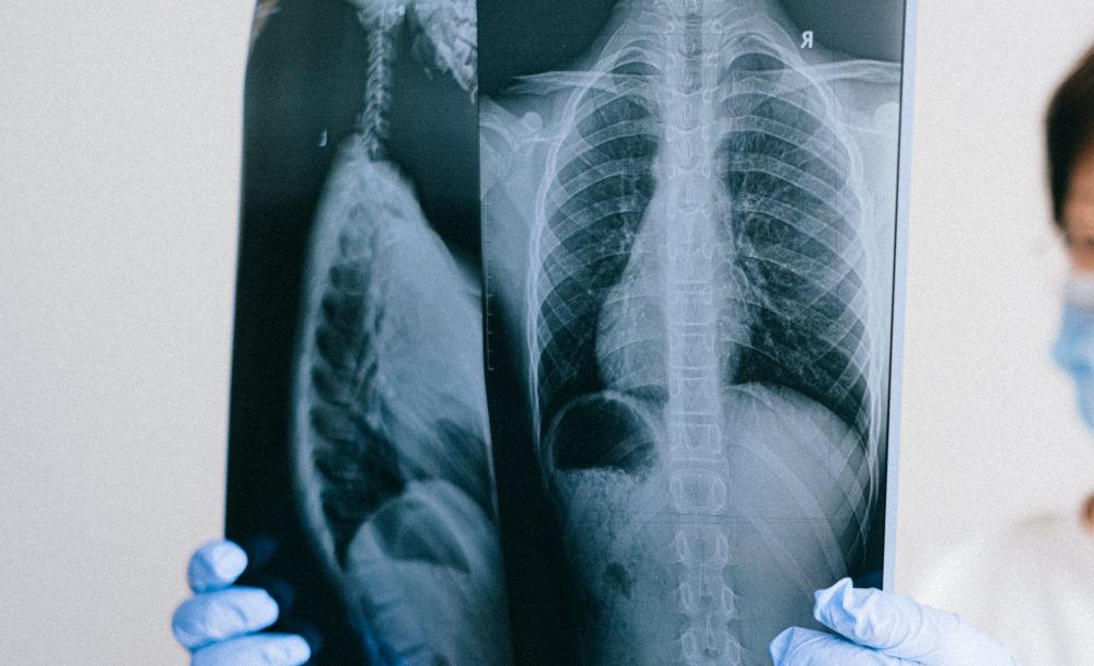 Απίστευτο περιστατικό στα Χανιά: Γυναίκα είχε για μήνες στον πνεύμονά της ένα κόκκαλο από κουνέλι