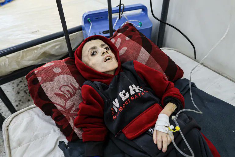 Απόλυτη φρίκη στη Γάζα: Παιδιά πεθαίνουν από την πείνα (Πολύ σκληρές εικόνες)