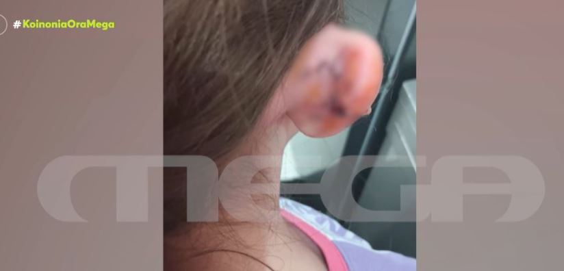 Αμφιλοχία: 9χρονη τραυματίστηκε σε κλειστή παιδική χαρά – Έκοψε το αυτί της (Video)
