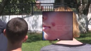 Σοκαριστικό περιστατικό bullying στην Πέλλα: Έσβηναν συχνά τσιγάρα στο μάγουλο 14χρονου, είχαν προσπαθήσει να τον πνίξουν με ζακέτα (Video)