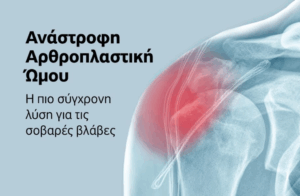 Ανάστροφη Αρθροπλαστική Ώμου: Σύγχρονη λύση για πολύπλοκα προβλήματα